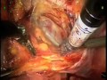 Radical Laparoscopic Cystoprostatectomy - Robot Assistance Radical Laparoscopic Cystoprostatectomy - Robot Assistance