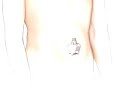 PreOp® Patient Education Hernia Hiatal Laparoscopic Surgery1  GERD Hernia