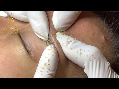 STRANGER THINGS_blackheads. Many people will enjoy it (17) | Loan Nguyen