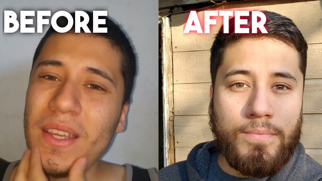 My minoxidil beard journey is officially complete | one year after stopping