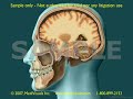 2D/3D Medical Animation: TBI - Traumatic Brain Injury Part 2