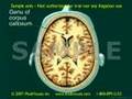2D/3D Medical Animation: TBI - Traumatic Brain Injury Part 2