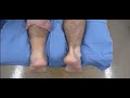 Achilles Tendon Tear Test