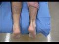 Achilles Tendon Tear Test