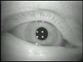 Tulsa Nystagmus 4