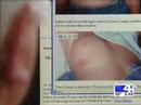 IBC: Inflammatory Breast Cancer news story