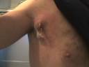 Bacterial Cyst In Chest