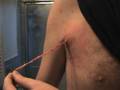 videos de Bacterial Cyst In Chest