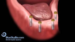 Overdenture