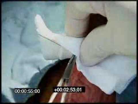 No-Scalpel, No-Needle,open ended ...