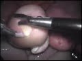 Laparoscopia para retirada de cisto em simulador EVA.