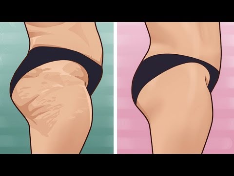 So wirst du Cellulite innerhalb von 7 Tagen ganz einfach los!