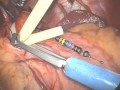 GERD Treatment - LINX Procedure GERD Treatment - LINX Procedure