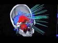 CyberKnife: Brain Tumor pt 2