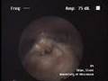 Examination video endoscopique du larynx de Steve Sklar
