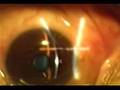 LASIK(レーシック)近視矯正手術