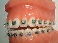 Orthodontic Cartoon Ligature Tie Hello Kitty