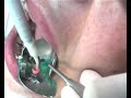 Laser.wmv