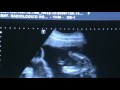 Sonograma de Trillizos (19 semanas) Part 1