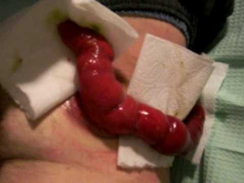 how to care for ileostomy care-stoma