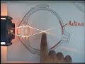 How the Eye focuses light on the Retina. Explanation of Short and Long-sightedness