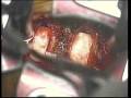 Anterior Discectomy in the Cervical Segment and Fusion Anterior Discectomy in the Cervical Segment and Fusion
