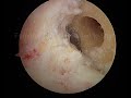 Arthroscopic Anterior Cruciate Ligament Reconstruction
