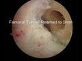 Arthroscopic Anterior Cruciate Ligament Reconstruction