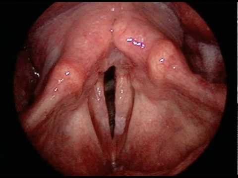 how to unclog your vocal cords