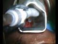 Endoscopic surgical management of a patient with relapsing polychondritis.
