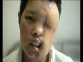 My Shocking Story: Human Face Transplant - Gou Shuzong