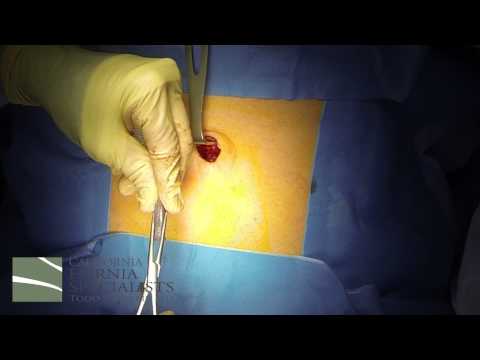 how to repair umbilical hernia