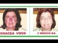 New, Unique!!! Impressive results. Acne/Rosacea disappears in 2 weeks by Rositta Method.