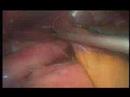 Cirug�a de Obesidad Ecuador