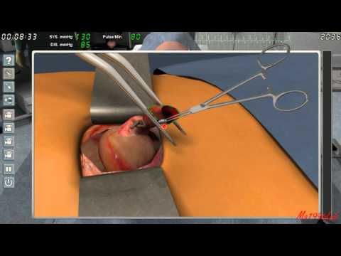 how to perform appendix surgery