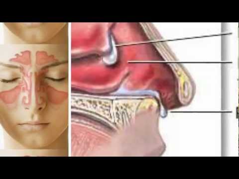 how to cure nasal polyps