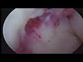 1,8cm zyste im knie 1,8cm zyste im knie