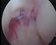 1,8cm zyste im knie