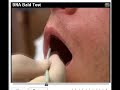 Hair Transplant Is One Option If New DNA Test Is Positive Hair Transplant Is One Option If New DNA Test Is Positive