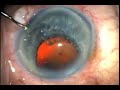 catarata-ifis-sindrome-iris-flacido-intraoperatorio.html