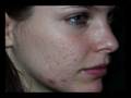 Acne Treatment