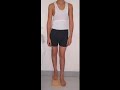 Limb Lengthening with Dr. Rozbruch: Jacob's Story