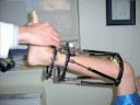 Limb Lengthening with Dr. Rozbruch: Jacob's Story