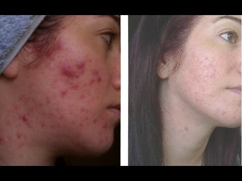 how to use exposed skin care