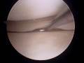 ZR Dr. Vangsness ACL surgery Part 4