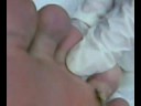 Cauterization my plantar wart