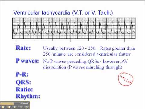 how to measure rate of v-tach
