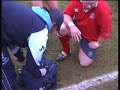 Sheffield RUFC - Tommys dislocated finger