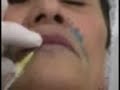 Preenchimento acido hialuronico