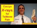Coccyx X-rays for TAILBONE PAIN